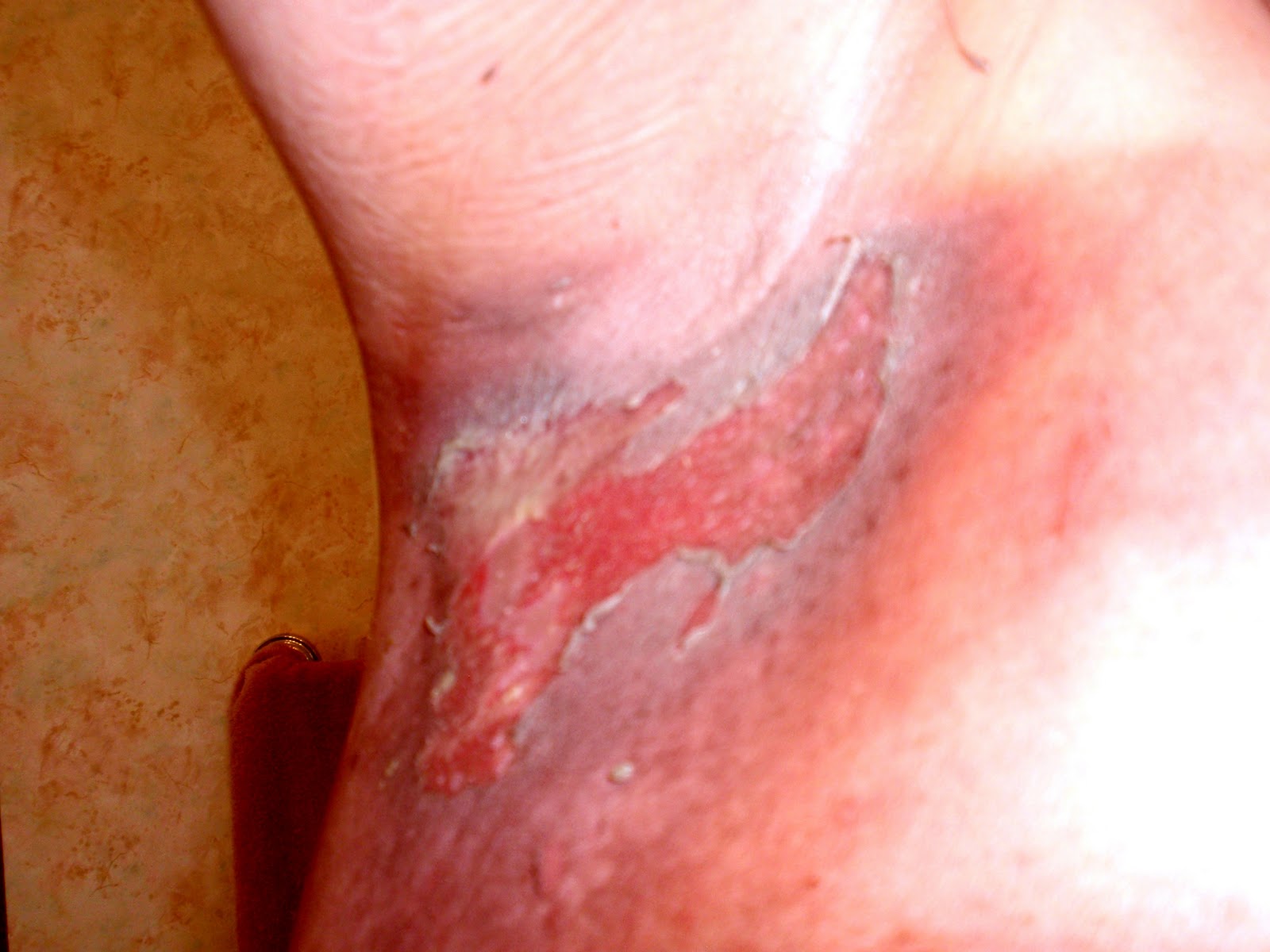 Final, breast reconstruction after radiation Curious topic breast reconstruction after radiation